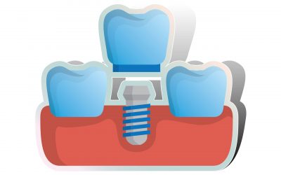 What Are Dental Implants?