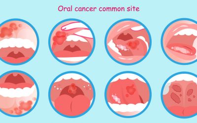 8 Tips to Prevent Oral Cancer