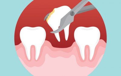 5 Reasons You May Need a Tooth Extraction