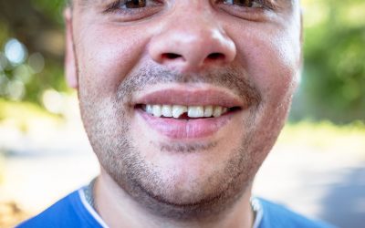 What to do About Broken or Chipped Teeth