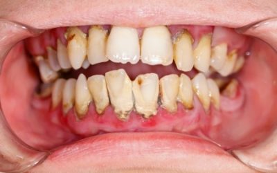 What Causes Cavities (and How to Avoid Getting Them)?