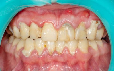 Gum Disease and the Cancer Link