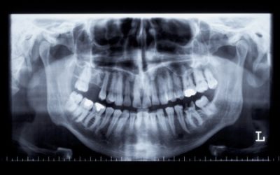 FAQs: The Safety of Dental X-rays