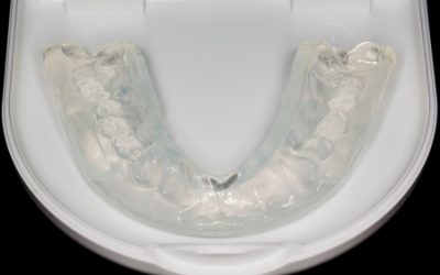 4 Signs You Need a Night Guard for Teeth Grinding