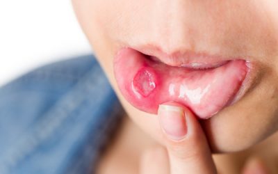 4 Common Causes of Canker Sores