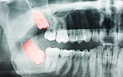 Recovery Tips after Wisdom Teeth Removal