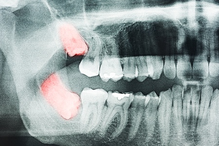 wisdom teeth removal swelling