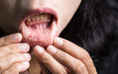 Signs and Symptoms of Oral Cancer