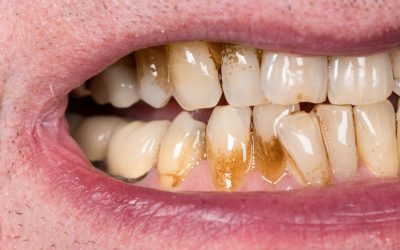 Receding Gums: When Should You Worry?