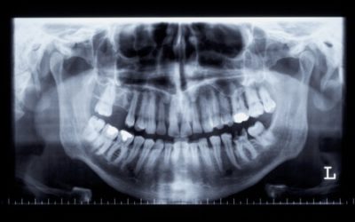 Do You Need Dental X-rays Every Year?