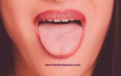 Salivary Gland Stones: What are they and How are They Treated?