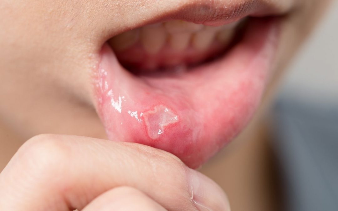 mouth-ulcer-types-causes-and-remedies