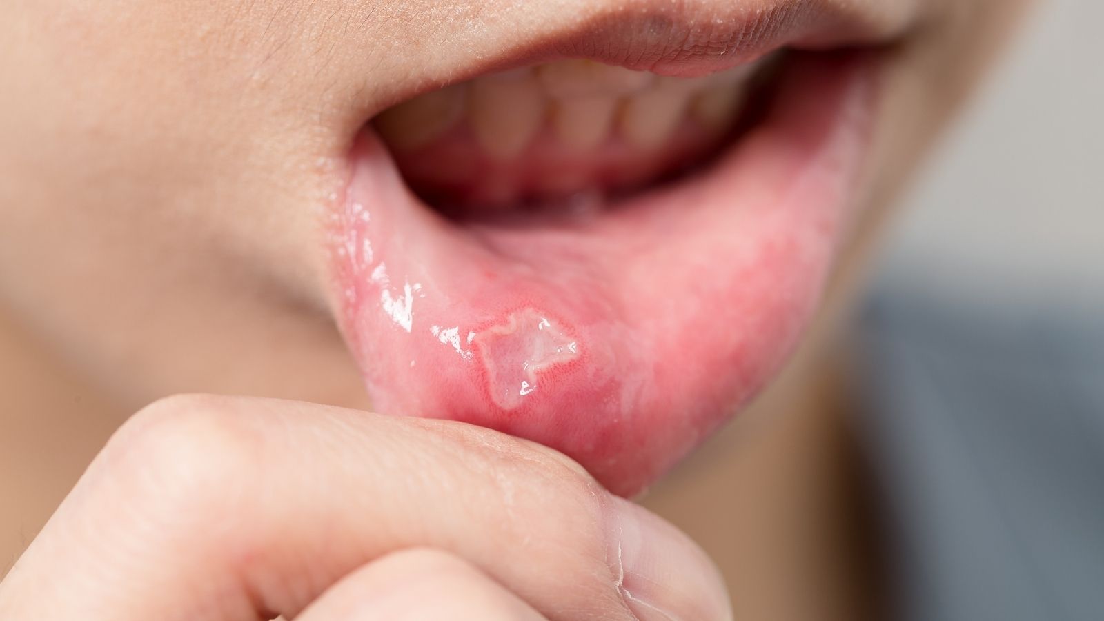 Oral Lesions Ulcers And Sores And How To Treat Them Danville Family 