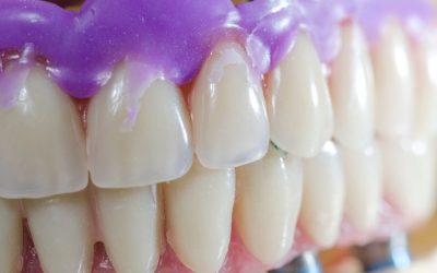 Dental Veneers Do More Than Fix Smiles