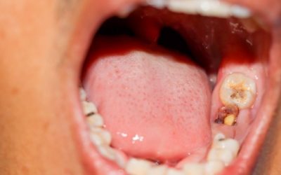 Brittle Teeth: Aches and Breaks