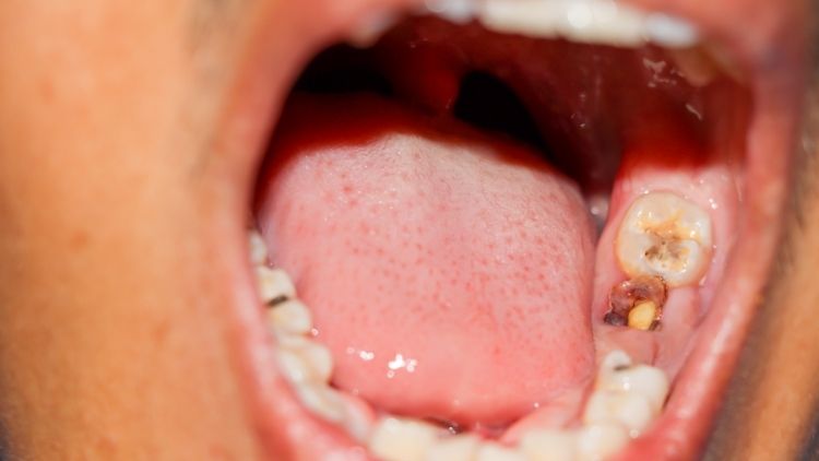 Brittle Teeth: Aches and Breaks