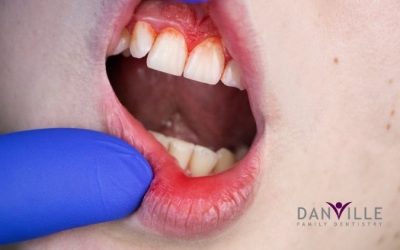 Deep Cleaning: Dental Scaling and Root Planing