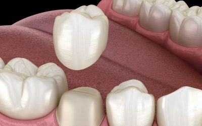 When Do You Need a Dental Crown?